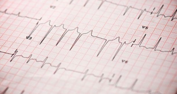 Elettrocardiogramma_Fibrillazione_Atriale_01